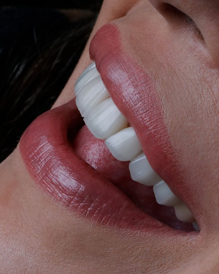 Detalhe de estética dental e labial Alevo